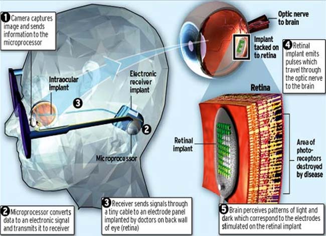 cybernetic eye implants