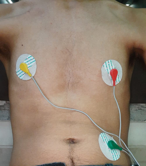 ECG Electrode Placement
