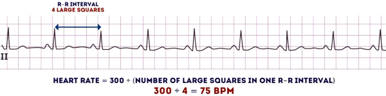 ECG Heart Rate Calculation